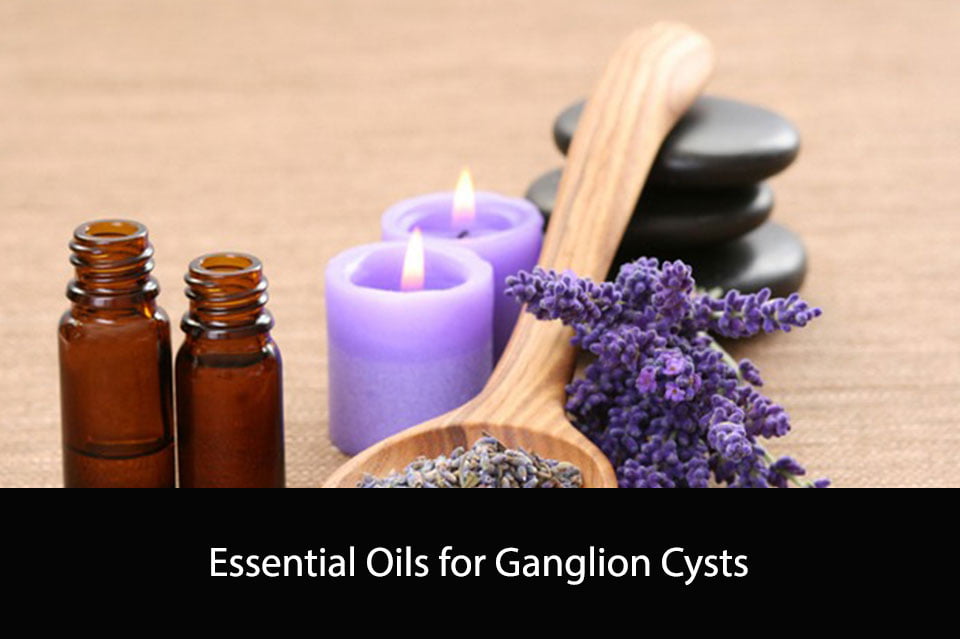 Essential Oils for Ganglion Cysts Natural Remedies