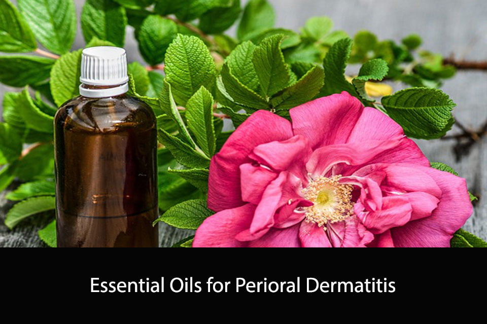 Essential Oils for Perioral Dermatitis Natural Remedies to Relieve